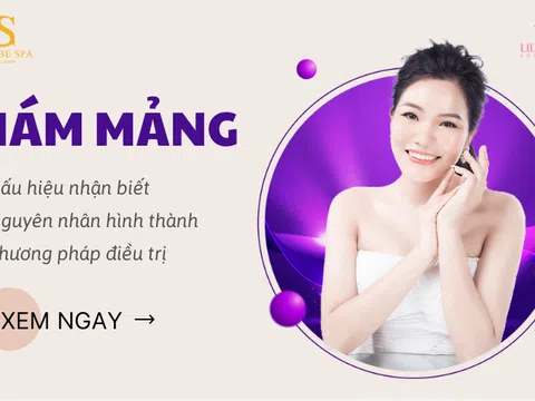 Nám Mảng: dấu hiệu nhận biết, nguyên nhân, phương pháp điều trị nám hiệu quả